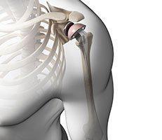 Shoulder Replacement
