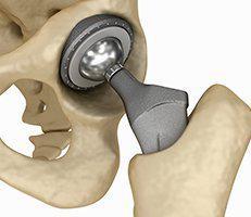 Total Hip Replacement