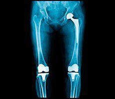 Joint Replacement
